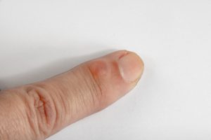 home remedy for ganglion cyst on finger