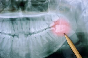 Treating Horizontally Impacted Wisdom Teeth By Dentists