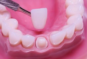 pain after dental crown