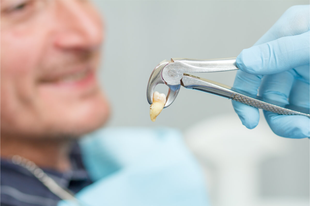 Tooth Extraction Recovery (Healing and Aftercare Tips)