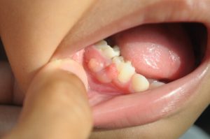 root canal therapy