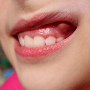solid fibrous gum tissue
