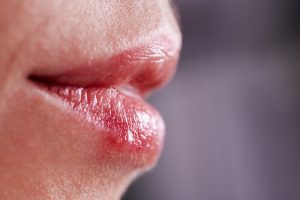 skin cancer canker sores